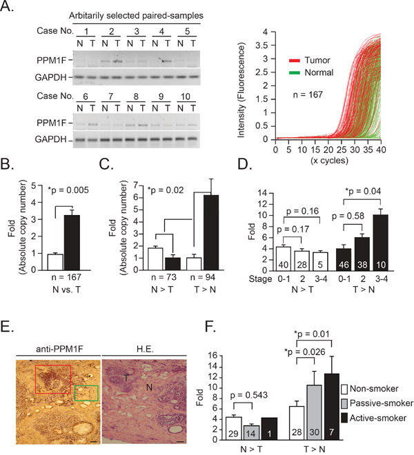 PPM1F mRNA and protein levels in human breast tumor tissues.