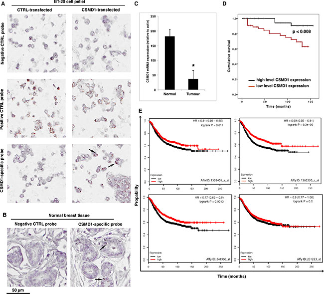 Detection of CSMD1 mRNA in normal breast tissue and quantitation of CSMD1 mRNA transcript in breast cancer tissues.