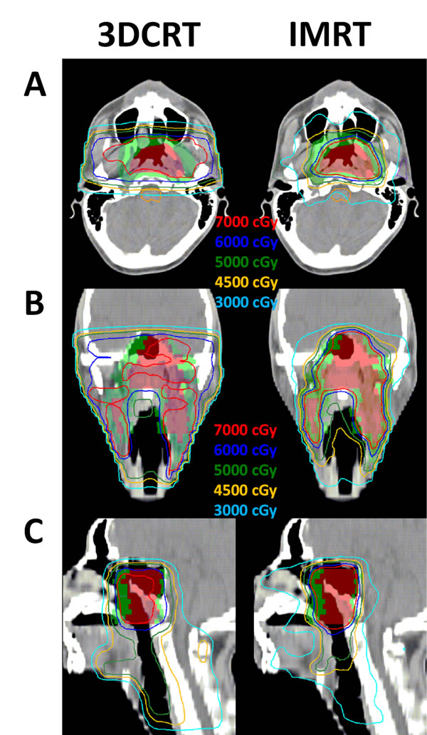 Isodose distributions in one NPC patient.