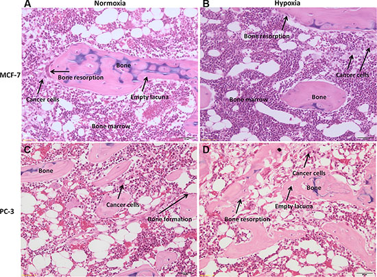 H/ E stained sections of human bone femoral head specimens grown in the presence of human cancer cells, both MCF-7 or PC-3, under normoxic and hypoxic conditions.