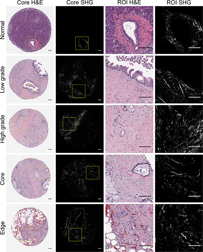 Representative pancreatic tissues visualized with H&#x0026;E staining and SHG microscopy.