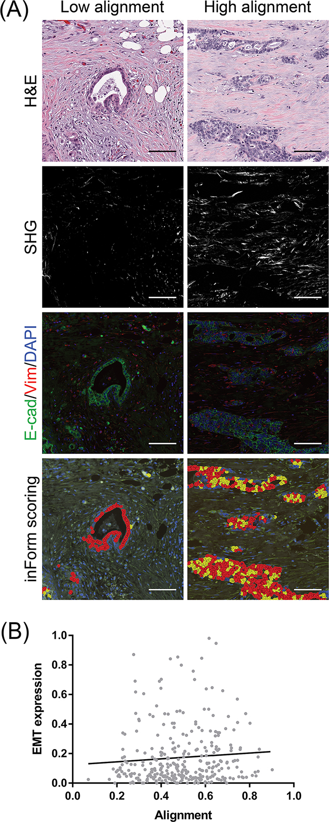 Co-localization of EMT-positive PDAC cells with stromal collagen alignment.