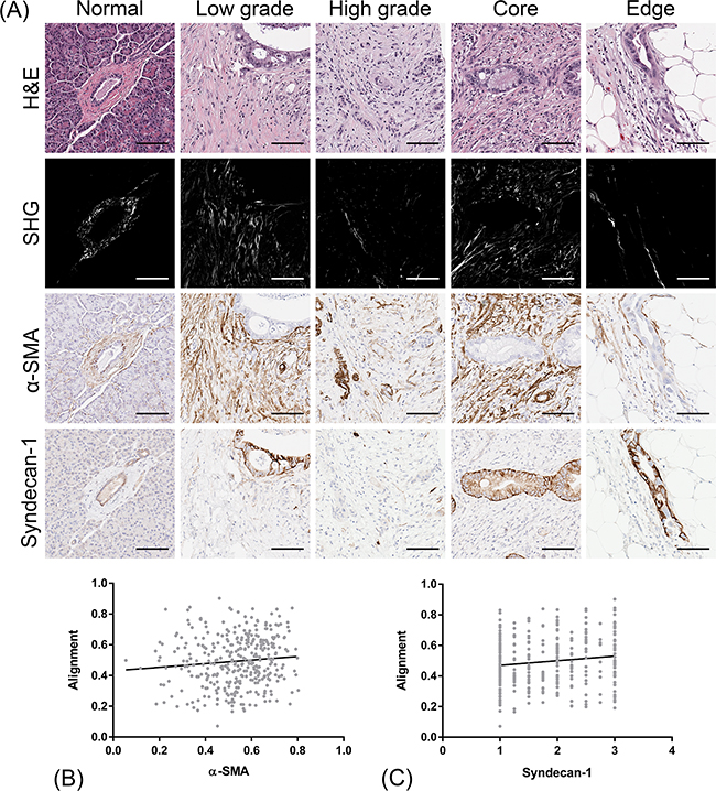 Co-localization of CAF markers (&#x03B1;-SMA and syndecan-1) with stromal collagen alignment.