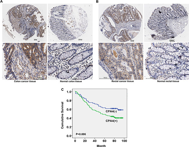 Expression of CPA4 in human primary colorectal cancer and normal tissues.