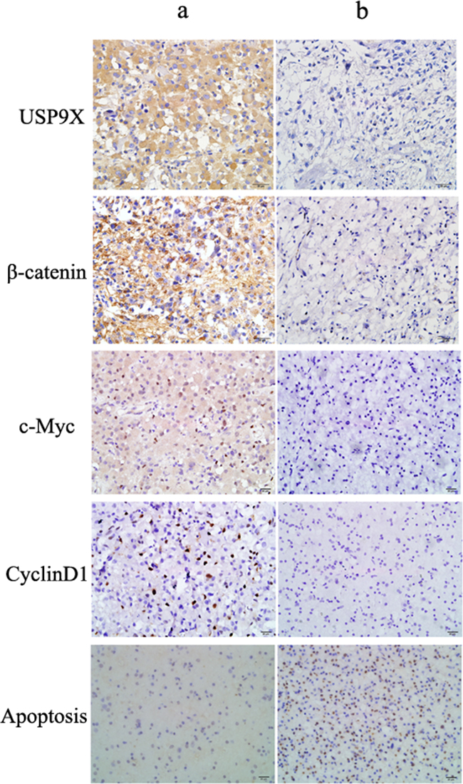 Representative immunohistochemical staining for USP9X, &#x03B2;-catenin, c-Myc and cyclinD1 in high grade glioma tissues.