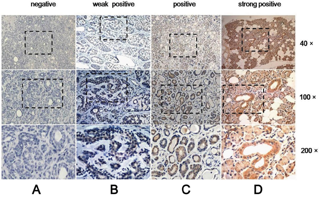 Expression of CDH4 in SACC is lower than in normal tissue.