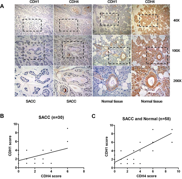 Expression levels of CDH4 and CDH1 are positively correlated in clinical SACC samples.