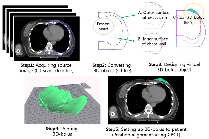 Schematic description of the procedures involves, which ranged from CT image acquisition to the placement of the 3D-printed bolus on the patient.