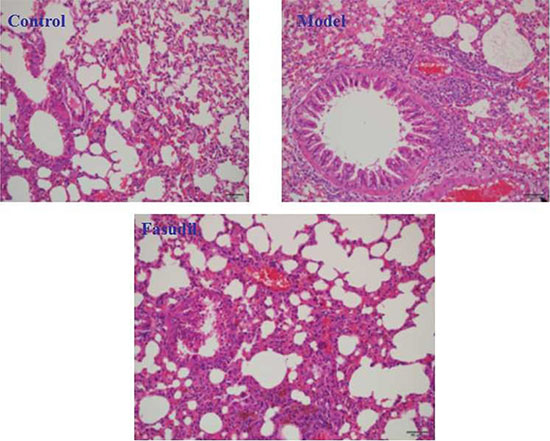 Fasudil inhibited cigarette smoke-induced infiltration of inflammatory cells in lung tissue.