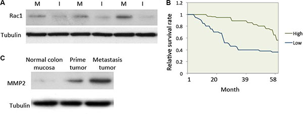 Rac1 expression was elevated in human metastatic colon cancer.
