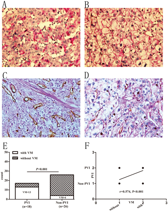 Prevalence of VM in HCC patients with and without PVI.