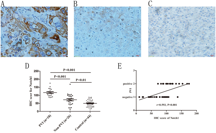 Immunohistochemical staining of Notch1 in HCC specimens and its association with PVI.