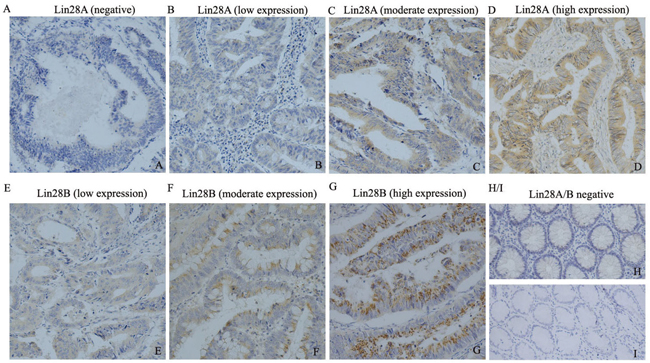 The expression pattern of Lin28A and Lin28B in colon cancer tissues detected by immunohistochemistry (200&#x00D7;).