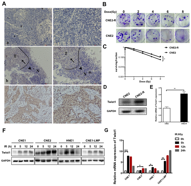 Twist1 is correlated with malignance and radioresistance of NPC.