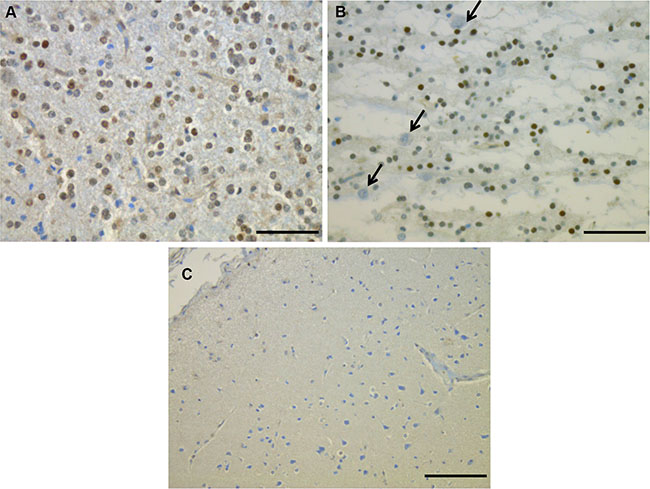 Phospho-FGFR1 protein expression detected by immunohistochemistry on two DNT cases: the immunoreactivity was restricted to the glial compartment (A and B) especially the oligodendroglial-like cells in the glial nodule (A) and the GNE (B).