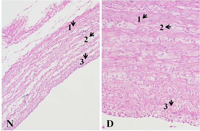 Histopathology changes of pulmonary artery tissues (200X, HE) The wall thickness of the Dis pulmonary artery sample was markedly thickening.