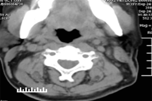 CT scan of the neck 6 months after surgery.