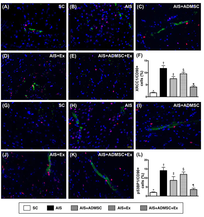 Microscopic findings of double-stranded DNA damaged positively stained cells in brain infarct zone by day 60 after AIS (