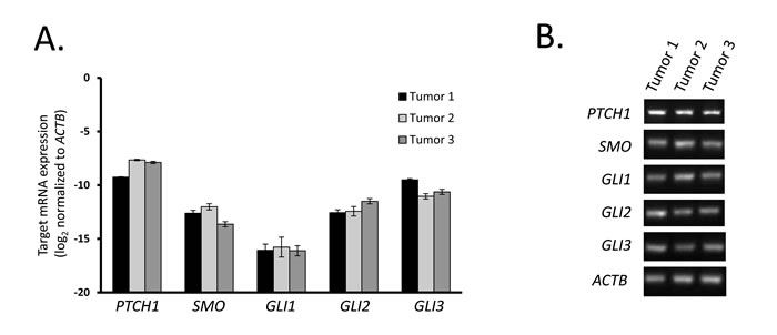 Tumor tissues from human GIST express Hedgehog signaling components.