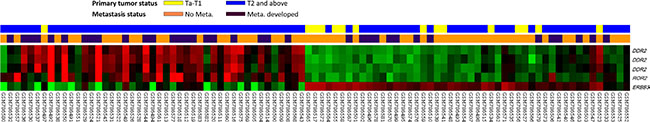 Gene expression profile analysis in urinary bladder urothelial carcinoma from a published transcriptomic dataset (GSE31684).