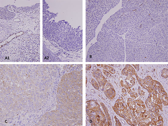 Representative lesions for DDR2 immunostaining reveals DDR2 is undetected in normal urothelium.