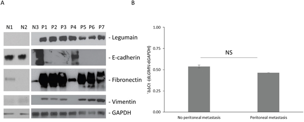 Legumain is overexpressed in gastric cancer patients with peritoneal metastasis.