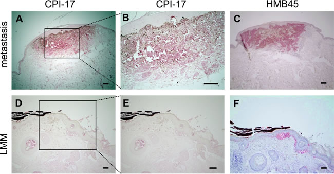 CPI-17 expression in human melanoma tissue samples correlates with HMB45 reactivity. (