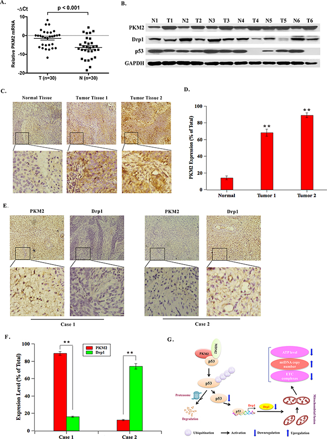 PKM2 is overexpressed in cervical cancer tissues and its expression is reversely correlated with Drp1 expression in clinical samples.