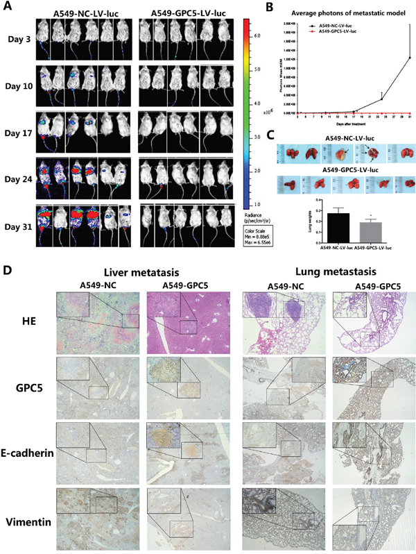 GPC5 inhibits lung adenocarcinoma and Epithelial-Mesenchymal Transition (EMT) in NOD-SCID mice model.