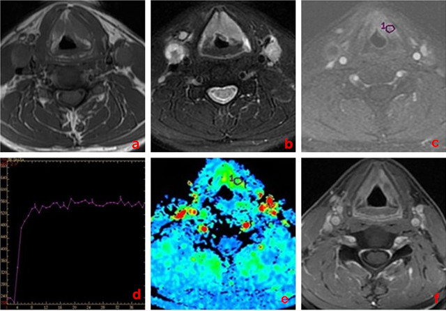A 58-year-old man with larynx carcinoma, good response to chemo-radiotherapy.