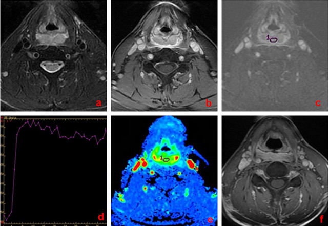 A 62-year-old man with hypopharynx carcinoma, poor response to chemo-radiotherapy.