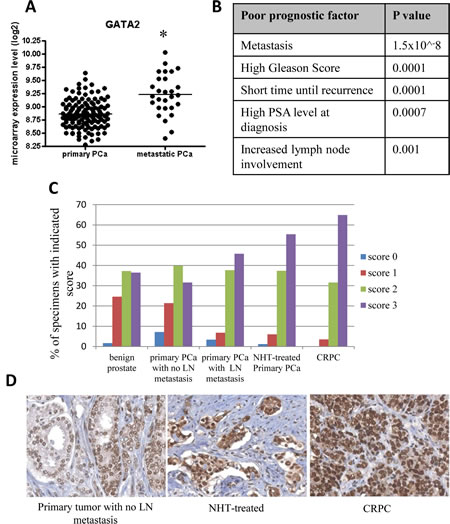 Elevated expression of GATA2 associated with poor prostate cancer (PCa) patient prognosis.