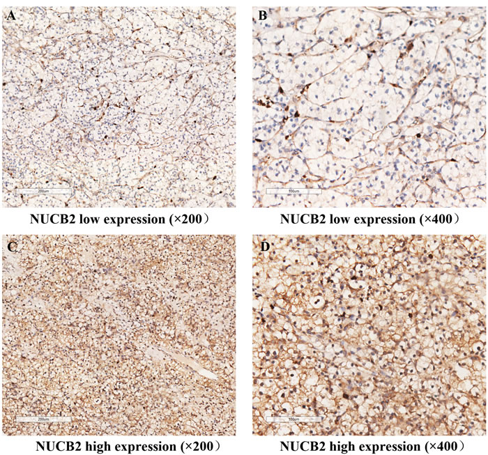 NUCB2 expression in clear-cell renal cell carcinoma (ccRCC) tissues.