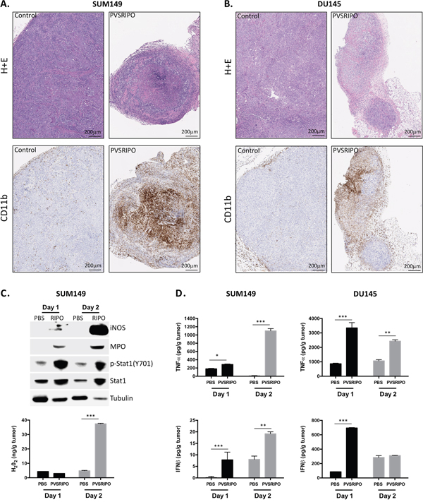 Innate immune cell infiltration after PVSRIPO is associated with signs of cell-mediated tumor cytotoxicity.