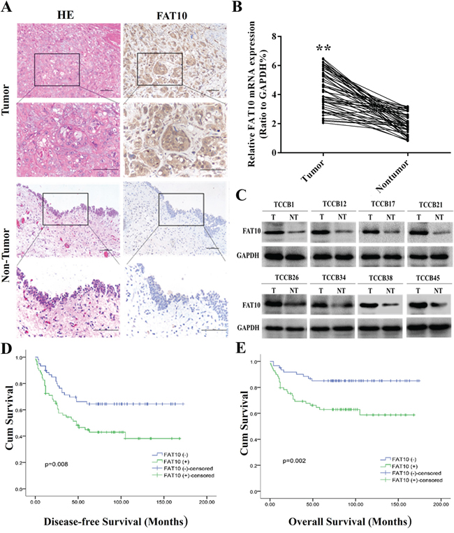 High FAT10 expression is associated with poor prognosis in bladder cancer patients.