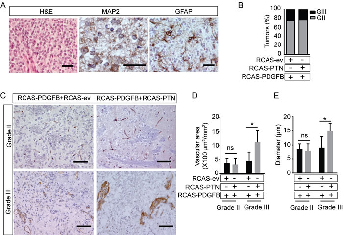 Co-infection with RCAS-PTN does not alter the histopathology of RCAS-PDGFB induced gliomas, but enhances angiogenesis and vascular abnormalization in high grade tumors.