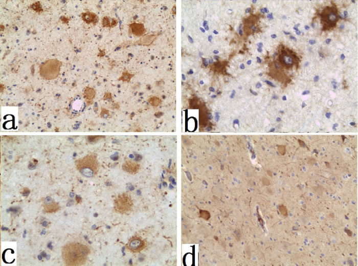 Immunohistochemistry of the FCD II BCs and DNs specimens.