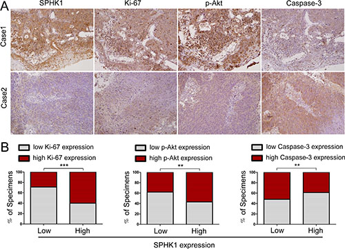 High SPHK1 expression was associated with increased Ki-67 and p-Akt and decreased caspase-3 expression in human NPC specimens.