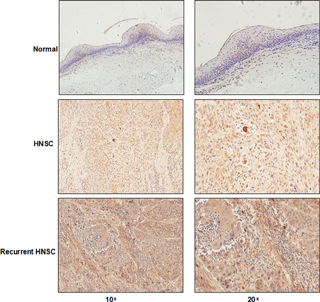 IHC analysis of syntenin-1 in HNSC.