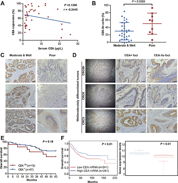 CEA-/lo cells are abundant in high-grade CRC tumors and positively correlate with poor prognosis.