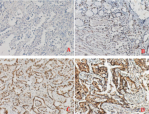The tissue expression of APE1 in non-small cell lung cancer.