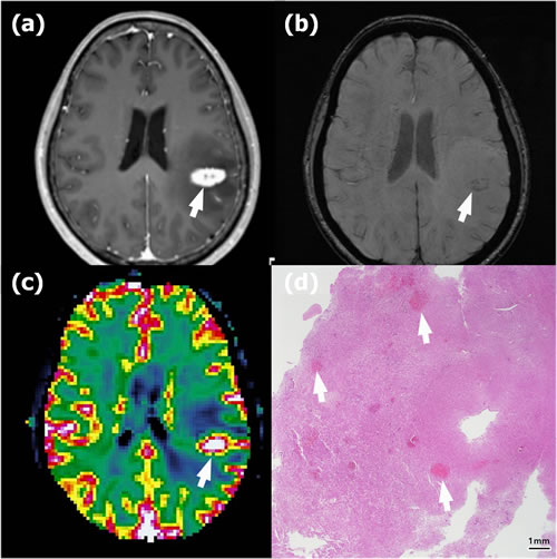 Recurrence in a 58-year-old woman with anaplastic astrocytoma in the left parietal lobe who underwent gross total resection and concomitant chemoradiotherapy (CCRT) with temozolomide.
