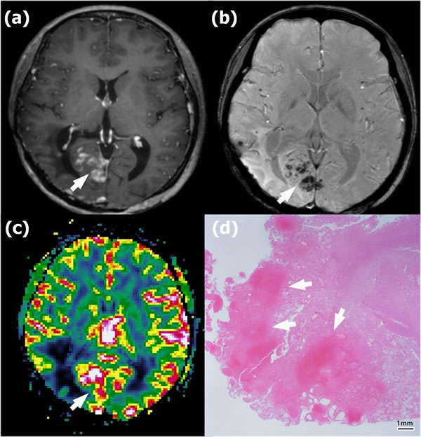 Radionecrosis in a 45-year-old woman with anaplastic astrocytoma in the right parietooccipital lobe who underwent gross total resection and concomitant chemoradiotherapy (CCRT).