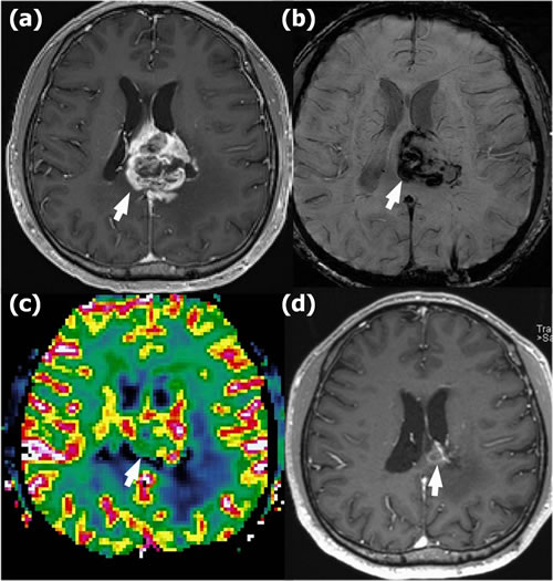 Radionecrosis in a 41-year-old man with glioblastoma in the left mid corpus callosum who underwent gross total resection and concomitant chemoradiotherapy (CCRT).