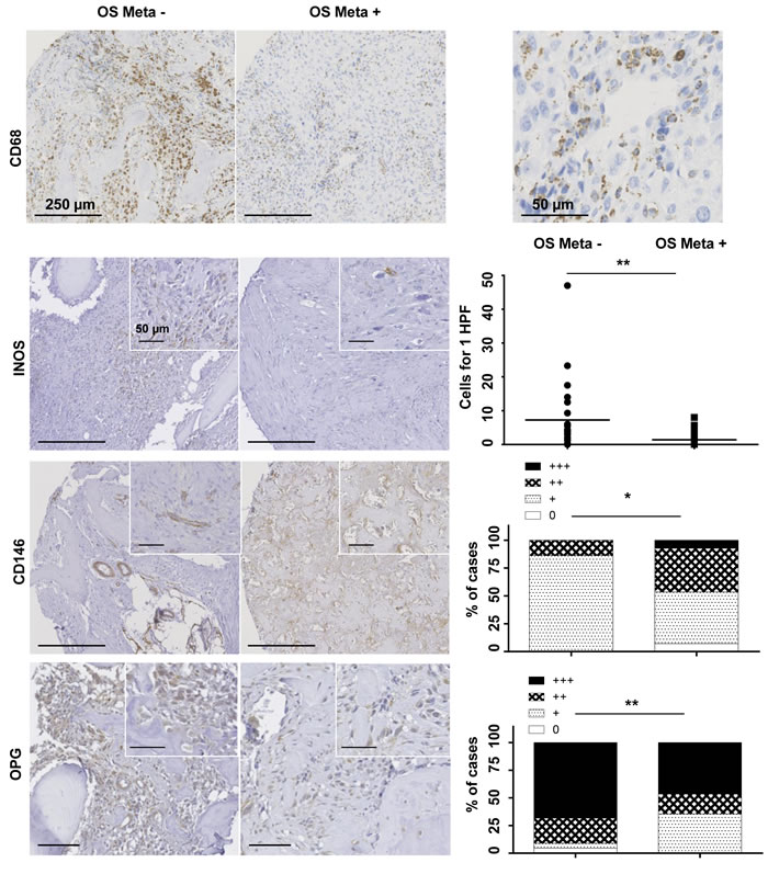Representative immunohistochemical results of CD68, INOS, CD146 and OPG, in primary lesions of OS Meta- and OS Meta