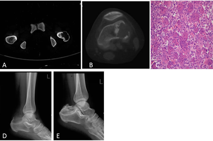 A 19-year-old woman with pathologic fracture of the greater trochanter of the left femur.