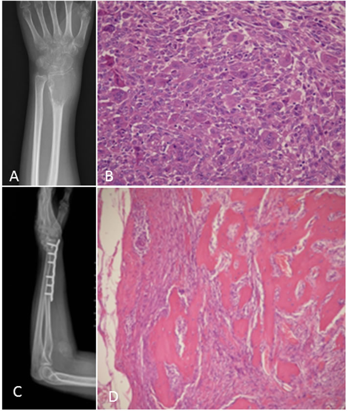 A 29-year-old woman with swelling and stiffness of the left distal radius.