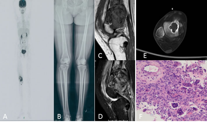 A 20-year-old woman with right knee swelling and pain.