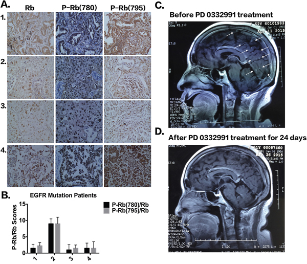 The expression of pRb and P-pRb in four patients with EGFR mutation.