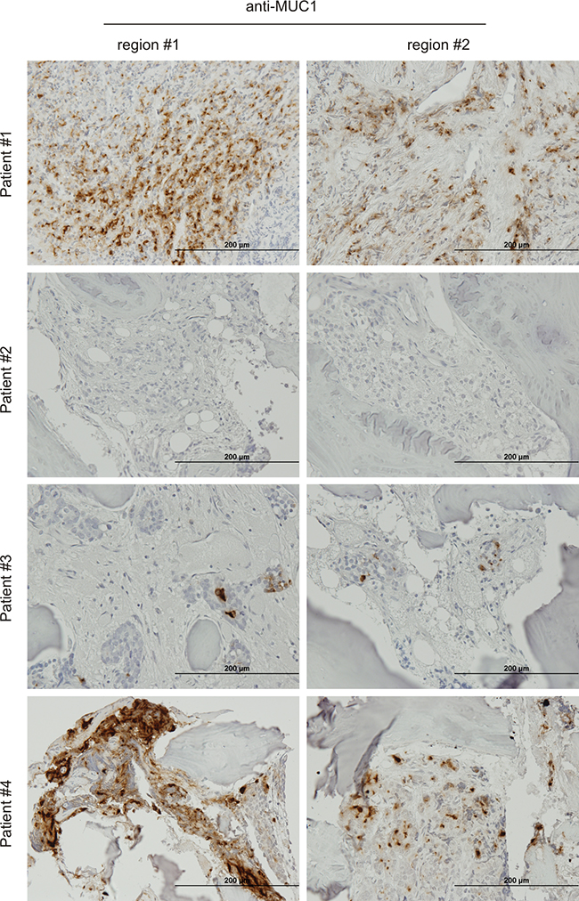 Expression of MUC1 in bone PC metastases.